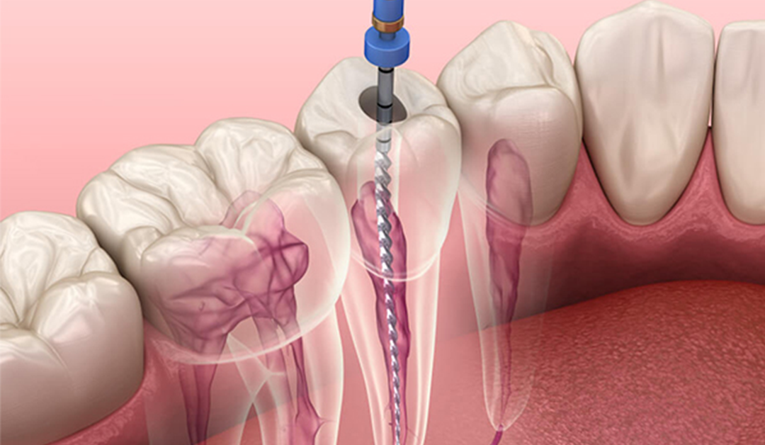 Root Canal vs. Tooth Extraction: What to Expect