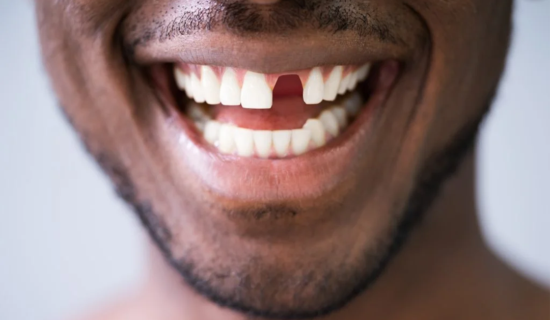 8 Problems caused by missing teeth
