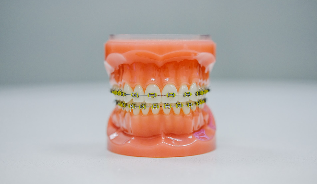 FAQs about Braces Answered