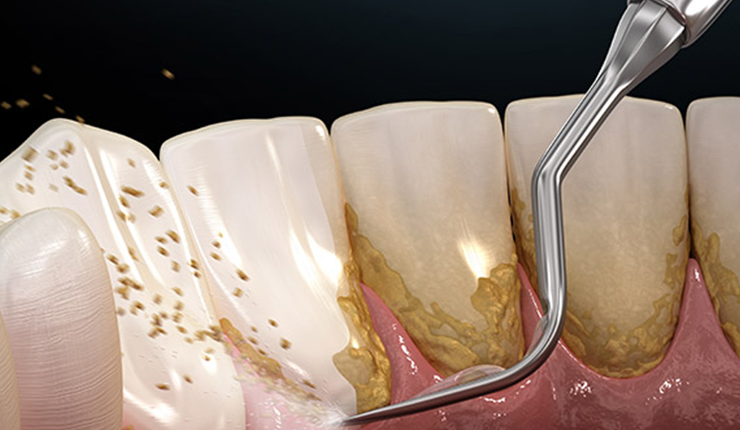 All You Need to Know About Dental Plaque