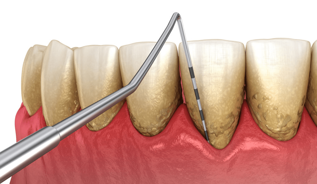 What Is Periodontal Disease?