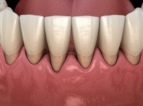 The Surprising Link Between Gum Disease and Cancer