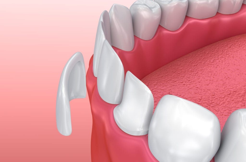 Questions To Ask a Dentist About Dental Veneers