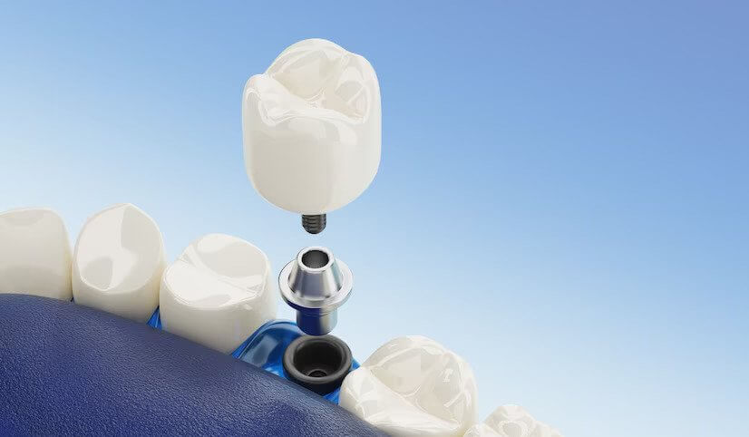 The Benefits of Dental Implants