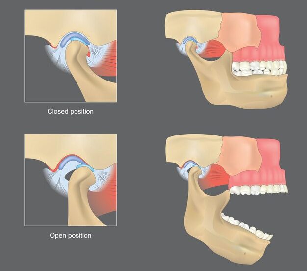 Understanding Temporomandibular Joint (TMJ) Disorders