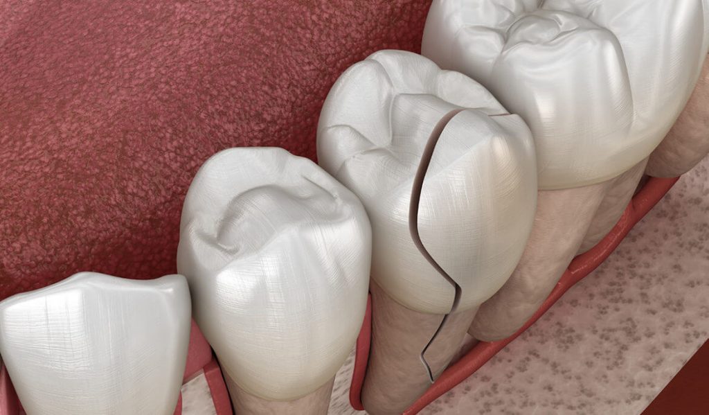 Understanding Dental Trauma: Causes, Symptoms, and Effective Treatment Approaches