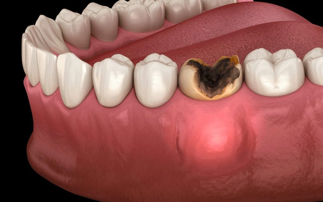 Understanding Dental Abscess: Causes, Symptoms, and Effective Treatment Approaches