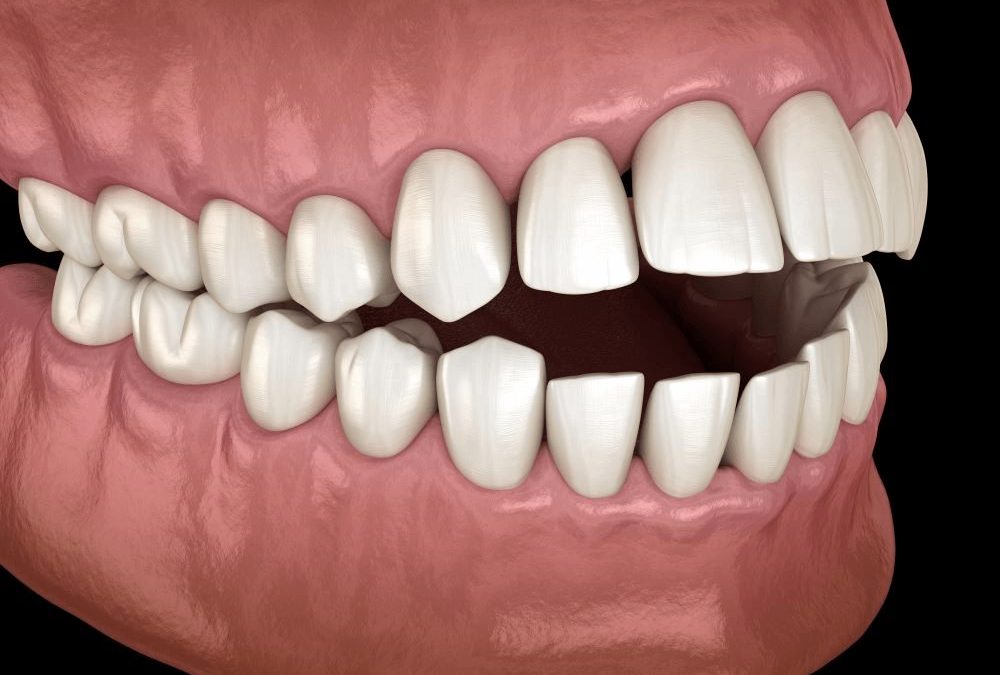 Malocclusion Demystified: Types, Causes, and Effective Treatment Approaches