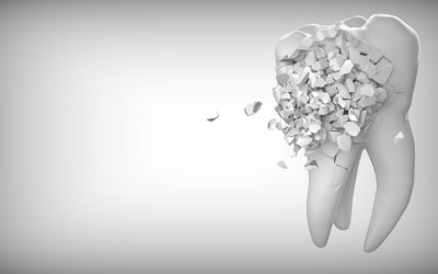 Understanding Tooth Erosion: Causes, Symptoms, and Treatment Options