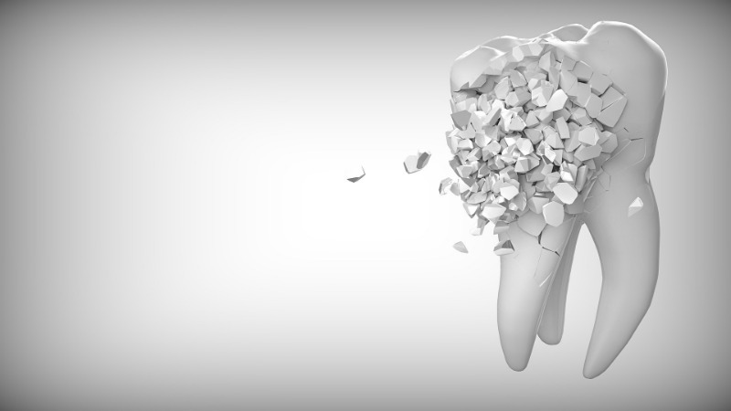 Understanding Tooth Erosion: Causes, Symptoms, and Treatment Options